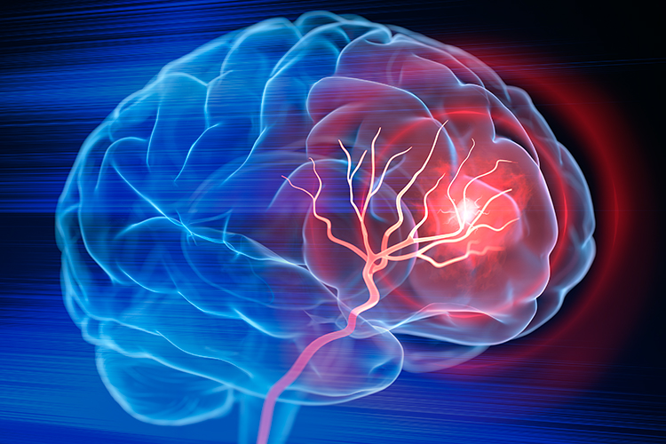 What’s a brain aneurysm? Q&A with two neurosurgeons | Edward-Elmhurst ...